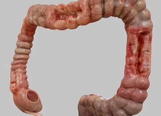 PBR Game 3D Models – Crohn’s Disease